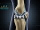 endoproteza kolena sucevic